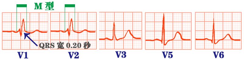 心电监护怎么看图图文并茂最全心电图，值得转发收藏_https://www.jmylbn.com_新闻资讯_第30张