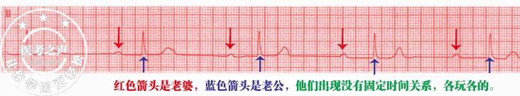 心电监护怎么看图图文并茂最全心电图，值得转发收藏_https://www.jmylbn.com_新闻资讯_第29张