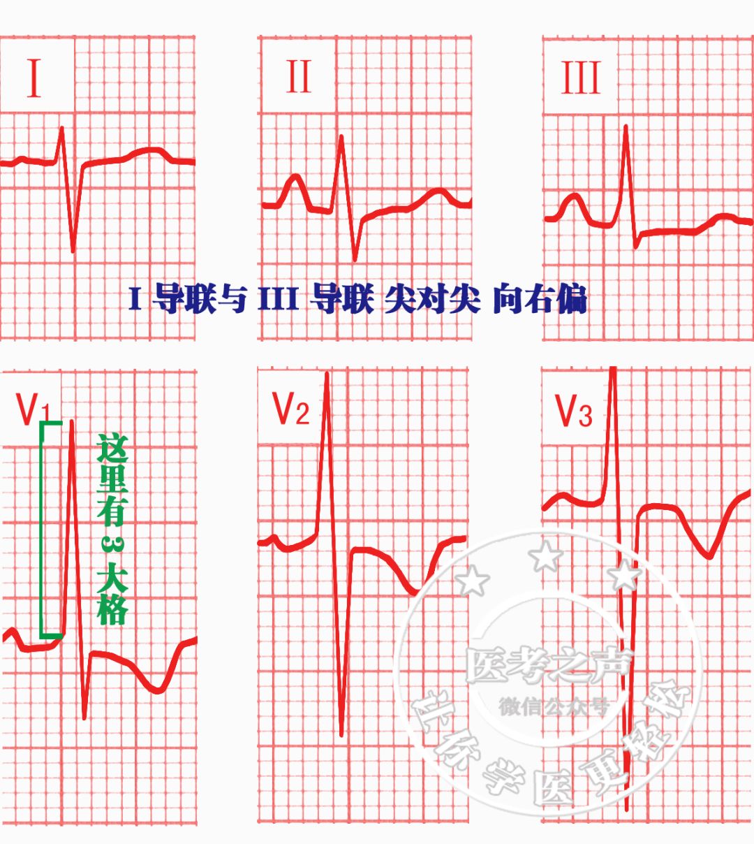 心电监护怎么看图图文并茂最全心电图，值得转发收藏_https://www.jmylbn.com_新闻资讯_第38张