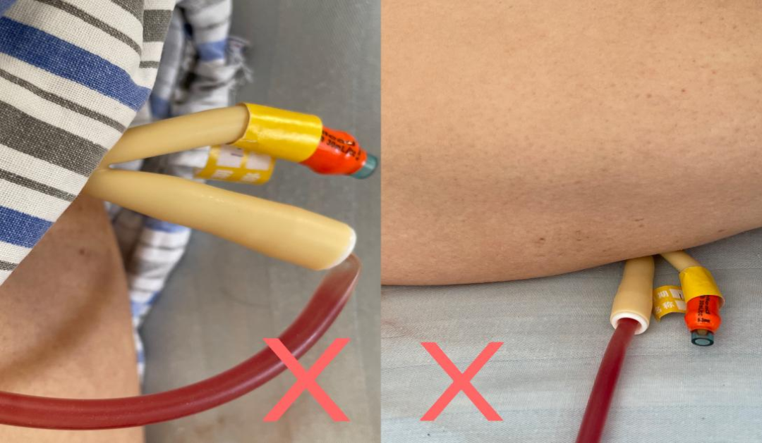 留置引流导管是什么中医护理76‖带“管”回家／留置导尿管的常见问题及处理_https://www.jmylbn.com_新闻资讯_第4张