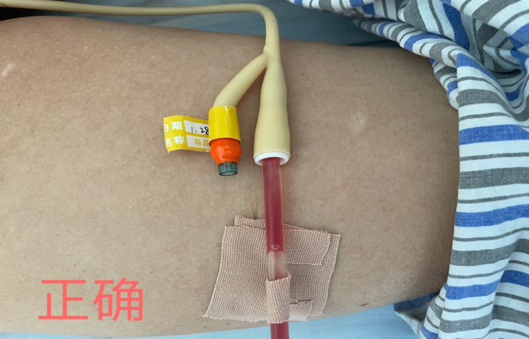 留置引流导管是什么中医护理76‖带“管”回家／留置导尿管的常见问题及处理_https://www.jmylbn.com_新闻资讯_第5张