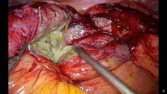 医生故事汇(十)---一根牙签的救赎!