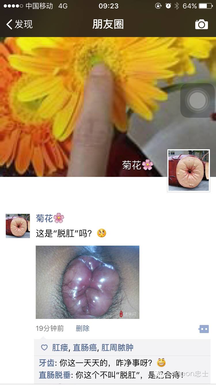 肛门 朋友圈系列 二 看看 脱肛 是啥样 直肠脱垂 疾病介绍