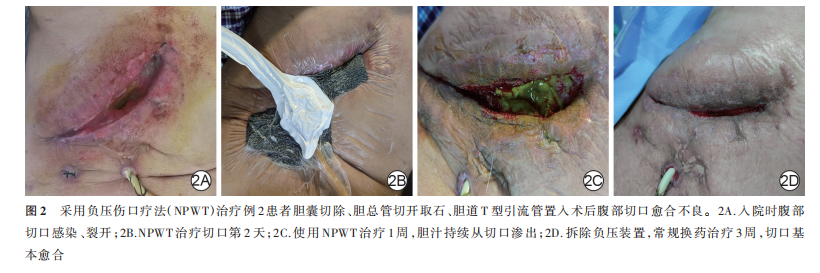 伤口负压治疗怎么收费论著｜负压伤口疗法治疗不同腹部疾病术后切口愈合不良的临床效果_https://www.jmylbn.com_新闻资讯_第5张