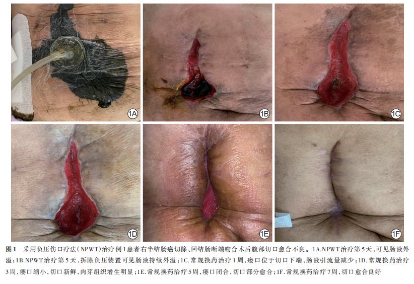 伤口负压治疗怎么收费论著｜负压伤口疗法治疗不同腹部疾病术后切口愈合不良的临床效果_https://www.jmylbn.com_新闻资讯_第4张