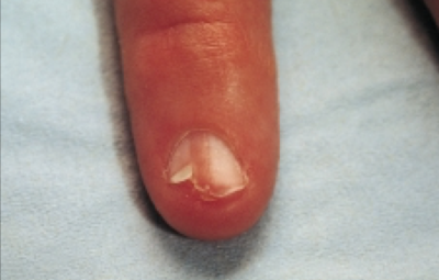 Nail disease in children(Imag from Chinese network) 