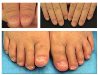 Nail disease in children(Imag from Chinese network) 
