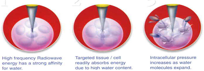 高频手术设备有哪些【宝藏设备】高频射频手术适用于哪些疾病？_https://www.jmylbn.com_新闻资讯_第2张