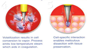 高频手术设备有哪些【宝藏设备】高频射频手术适用于哪些疾病？_https://www.jmylbn.com_新闻资讯_第3张
