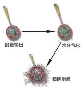 高频手术设备有哪些【宝藏设备】高频射频手术适用于哪些疾病？_https://www.jmylbn.com_新闻资讯_第6张