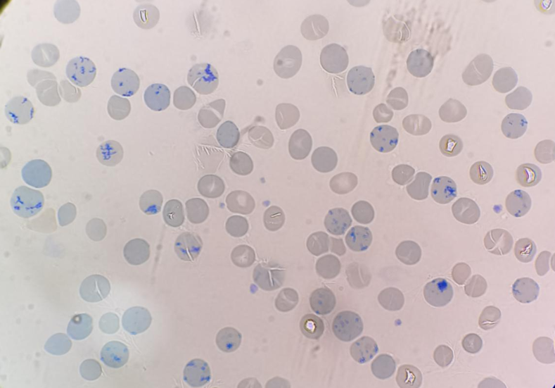红细胞聚集导致的仪器法网织红细胞计数偏差一例_医学界-助力医生临床