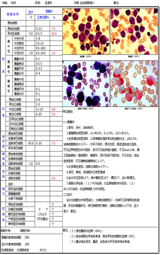 骨髓細胞形態學檢查(詳見報告單)外周血瑞氏染色(1000x)血塗片示白