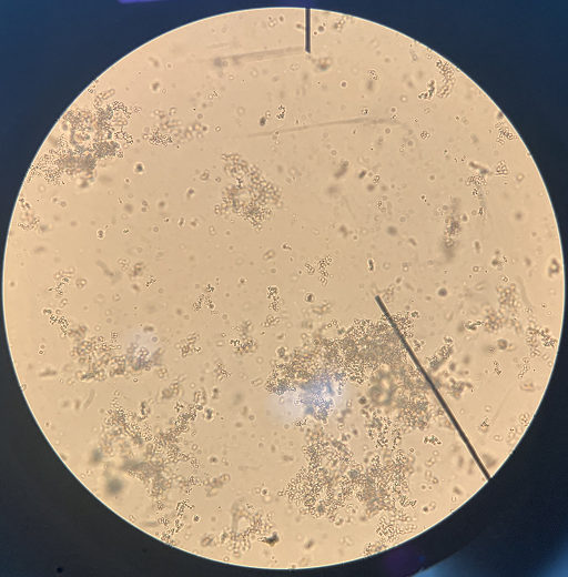 尿常规蛋白阴性而尿微量白蛋白测定高值,原因竟是.