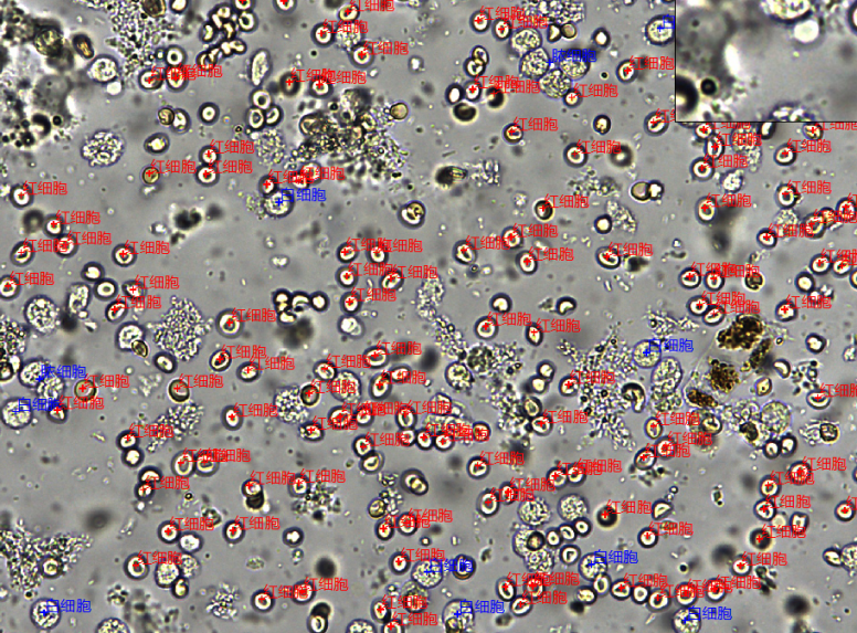 该份粪便标本外观为红色,软便,40倍镜下可见大量红细胞及白细胞,如图2