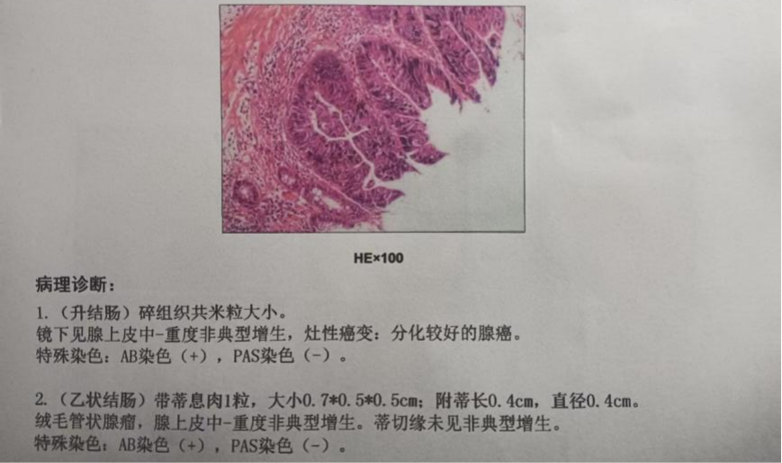 小檢查,大效用——多學科聯合診療前列腺癌併發結腸癌的案例_醫學界