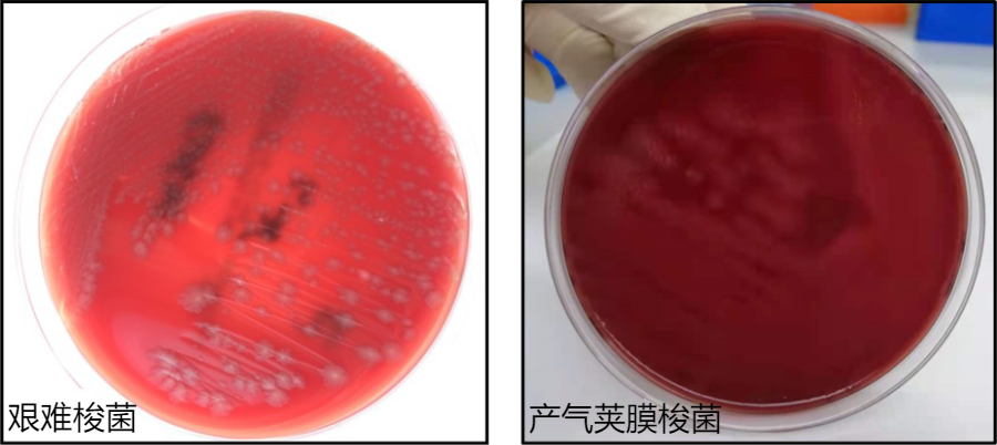 一例c型產氣莢膜梭菌感染性腹瀉繼發多器官功能衰竭的診療_醫學界