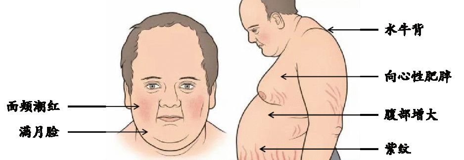 以内分泌检验为基础的mdt诊断库欣综合征1例分析