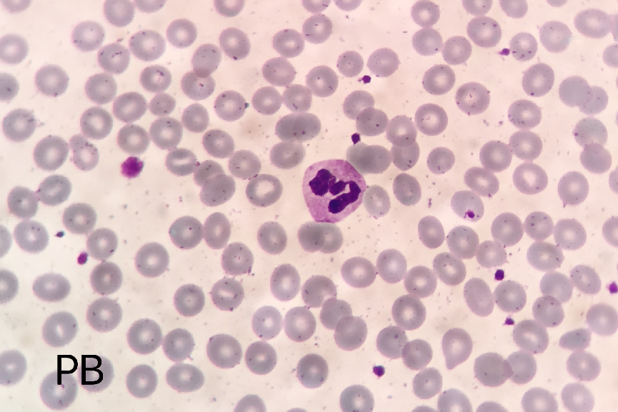 嗜酸性粒细胞的假性增高的原因分析_医学界-助力医生临床决策和职业