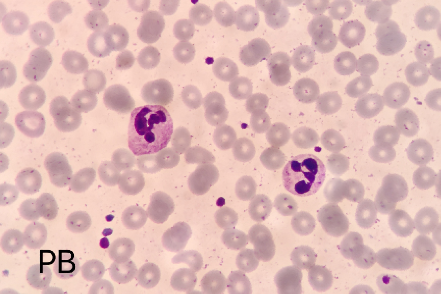 结果也是同阅片机的结果一样,镜下均为中性粒细胞,嗜酸性粒细胞在正常