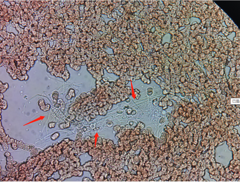 图7:油镜下,纤维蛋白丝图6:油镜下,纤维蛋白丝图5:油镜下,蓝色团块