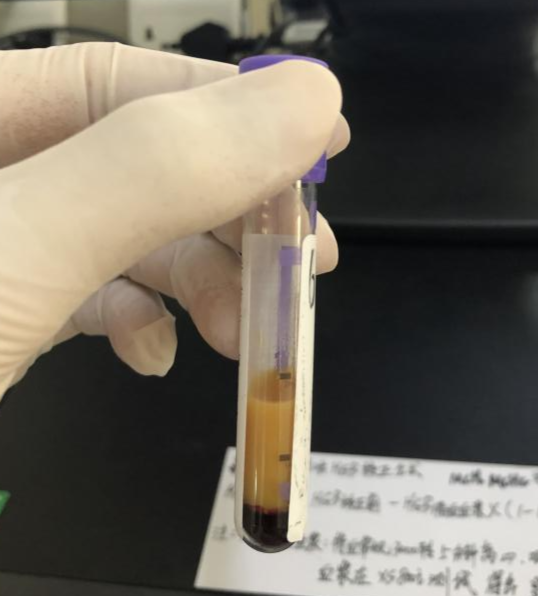 两个公式对比解决乳糜血hgb问题