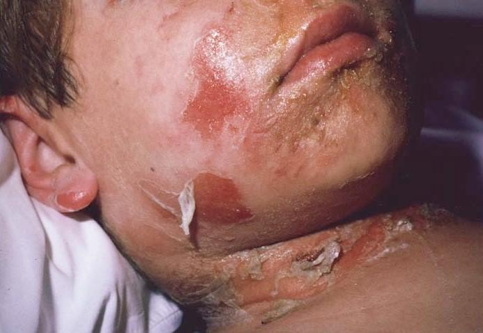 葡萄球菌烫伤样皮肤综合征一例_医学界-助力医生临床决策和职业成长