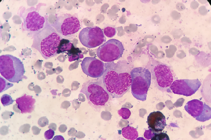 原发性浆细胞白血病一例分享_医学界-助力医生临床决策和职业成长