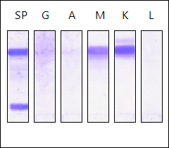 免疫球蛋白igm升高,血清免疫固定电泳发现igm-k异常单克隆条带(图4)