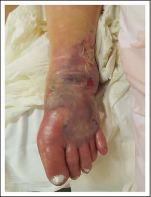 坏死性皮肤和软组织感染铜绿假单胞是住院烧伤患者伤口感染的主要原因