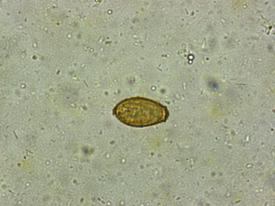 我们根据血常规嗜酸性粒细胞比率增高,怀疑有肝吸虫卵.