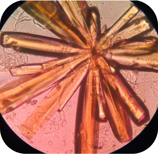 神奇的「菊花狀」結晶_醫學界-助力醫生臨床決策和職業成長