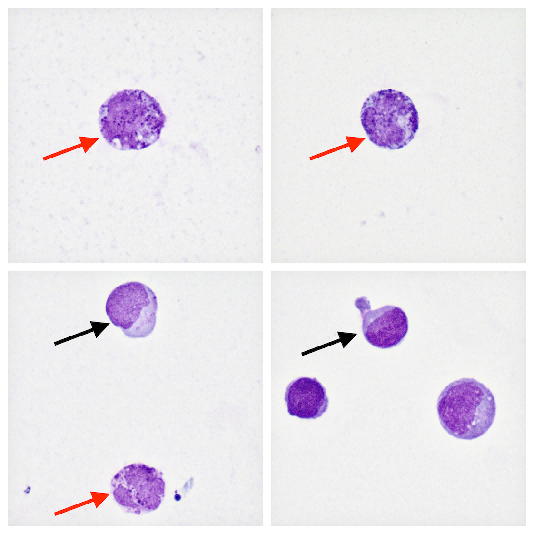 cnsl脑脊液中的嗜碱性粒细胞_医学界-助力医生临床决策和职业成长