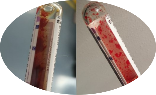 图1 未经处理的原标本检测页面红细胞与血红蛋白不成比例,mch和mchc极