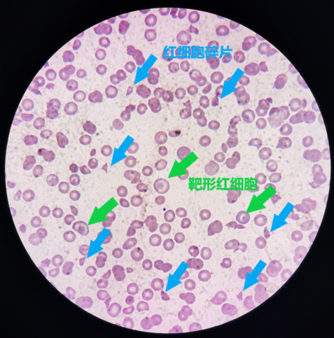 鏡下結果血小板與網織紅細胞通道結果基本一致,鏡下還可見大量的細胞