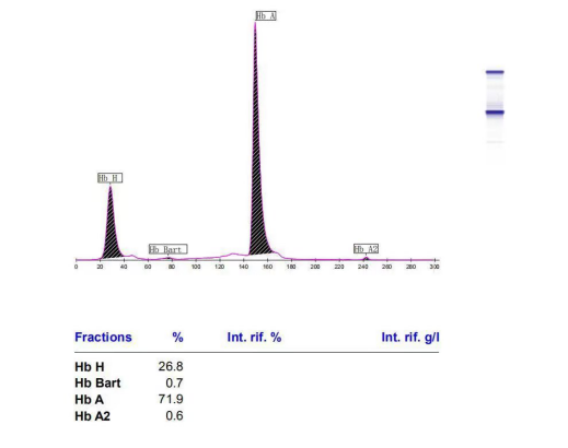 一例血红蛋白h病引起高值糖化血红蛋白的病例分析_医学界-助力医生