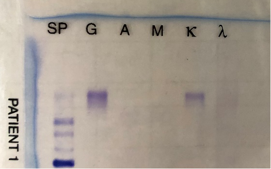 一例特殊的免疫固定电泳结果解读