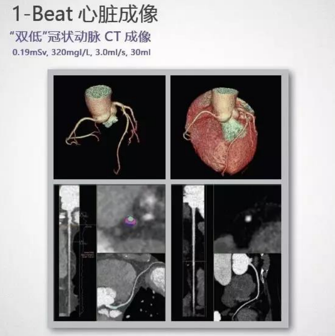 GE病人列表怎么删除​【院之重器】GE Revolution 256排超高端CT：让诊断更快，更精准！_https://www.jmylbn.com_新闻资讯_第3张