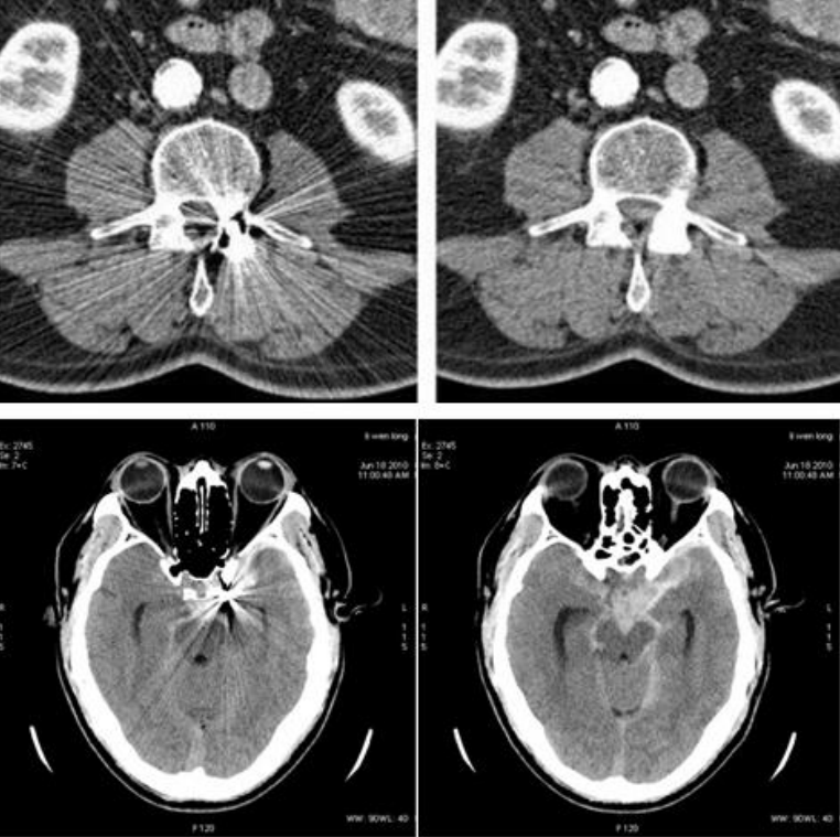 GE病人列表怎么删除​【院之重器】GE Revolution 256排超高端CT：让诊断更快，更精准！_https://www.jmylbn.com_新闻资讯_第7张