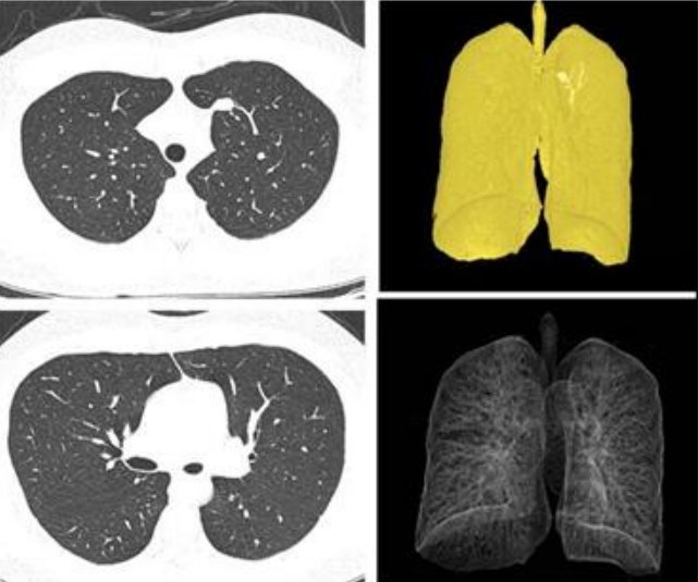 GE病人列表怎么删除​【院之重器】GE Revolution 256排超高端CT：让诊断更快，更精准！_https://www.jmylbn.com_新闻资讯_第6张