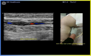 logiq e怎么读重磅！县人民医院引进最新 LOGIQ™  E11 全“芯”高端全身超声系统，已投入使用！_https://www.jmylbn.com_新闻资讯_第6张