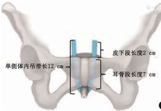 尿道张力过强怎么回事女性重度“压力性尿失禁”患者的福音——耻骨后经阴道尿道中段无张力悬吊术_https://www.jmylbn.com_新闻资讯_第6张