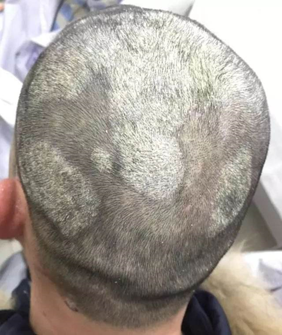 头癣形成的原因及调理