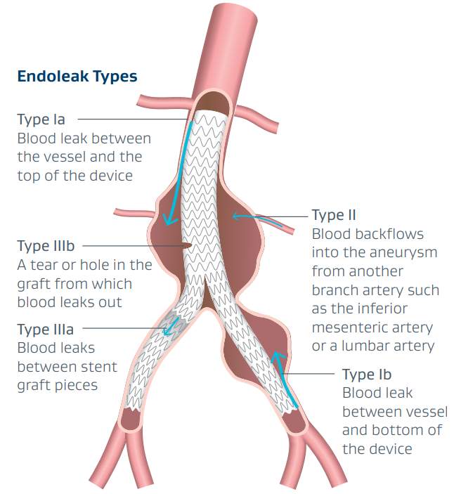 gore医疗怎么样四分支现成方案治疗复杂腹主和IV型胸腹主动脉瘤_https://www.jmylbn.com_新闻资讯_第12张