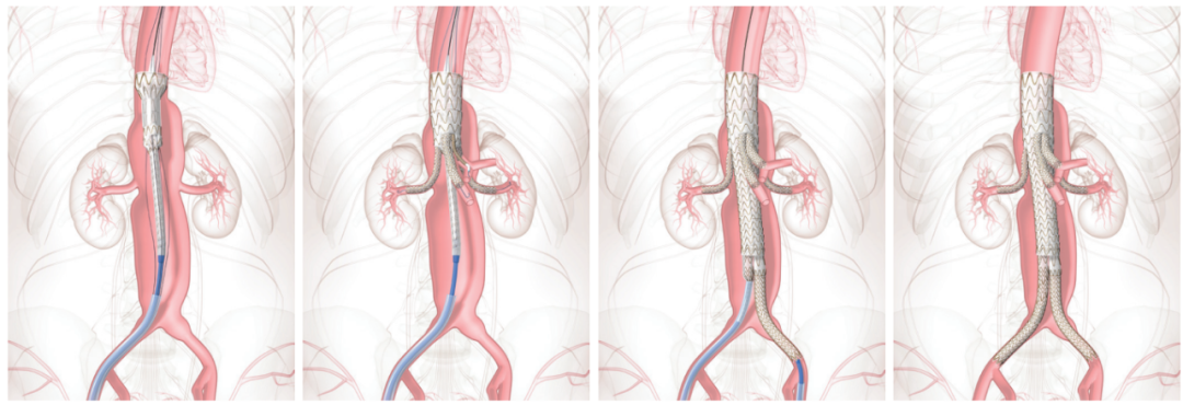 gore医疗怎么样四分支现成方案治疗复杂腹主和IV型胸腹主动脉瘤_https://www.jmylbn.com_新闻资讯_第11张