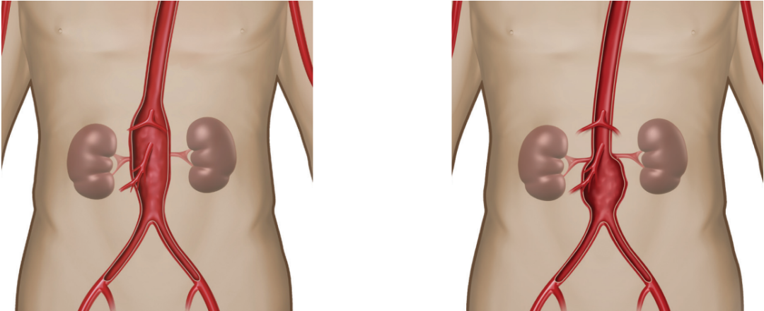 gore医疗怎么样四分支现成方案治疗复杂腹主和IV型胸腹主动脉瘤_https://www.jmylbn.com_新闻资讯_第8张