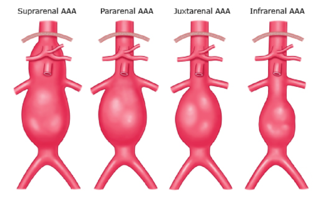 gore医疗怎么样四分支现成方案治疗复杂腹主和IV型胸腹主动脉瘤_https://www.jmylbn.com_新闻资讯_第6张