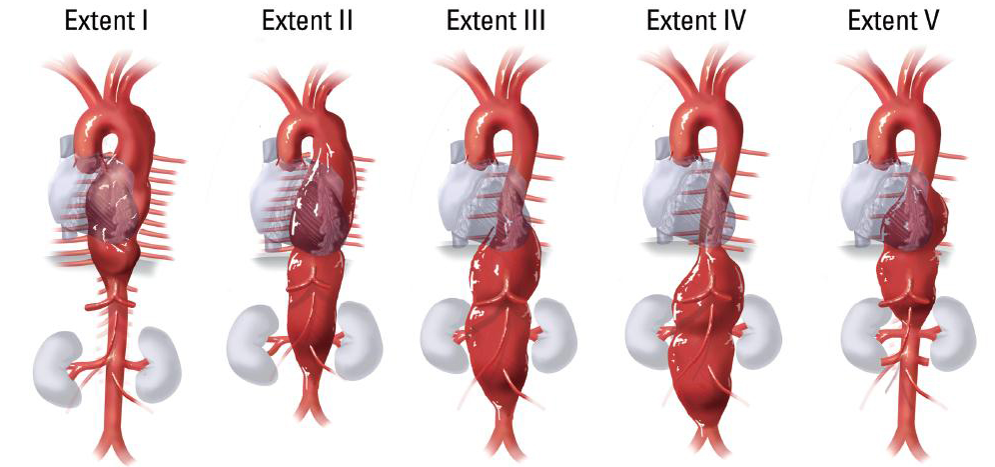 gore医疗怎么样四分支现成方案治疗复杂腹主和IV型胸腹主动脉瘤_https://www.jmylbn.com_新闻资讯_第7张