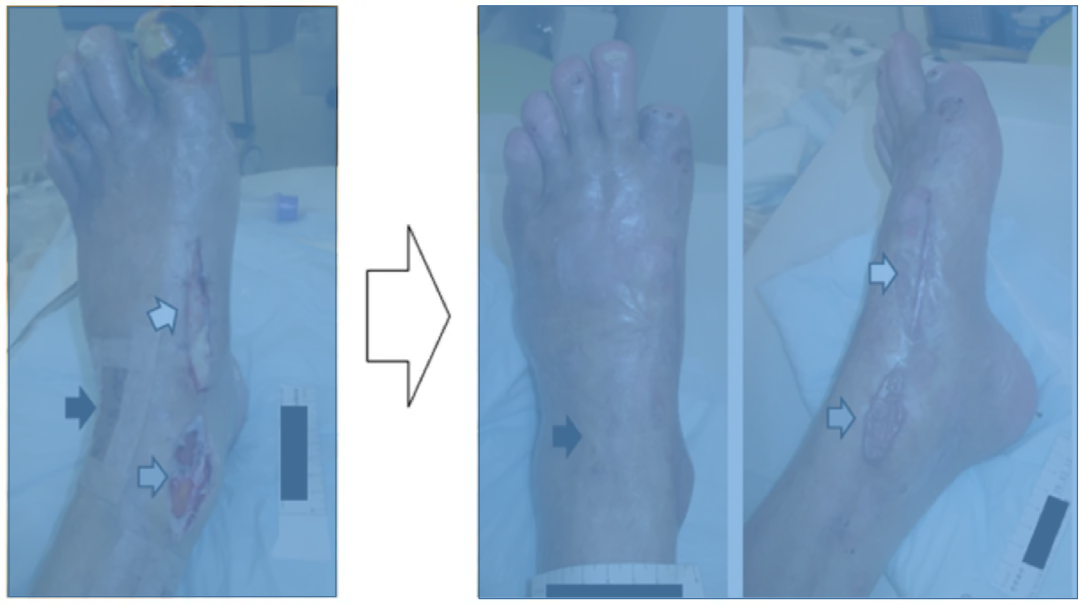 pta在医学上什么意思足背动脉旁路术：从技术革新到精准医疗_https://www.jmylbn.com_新闻资讯_第21张