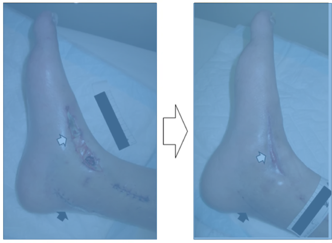 pta在医学上什么意思足背动脉旁路术：从技术革新到精准医疗_https://www.jmylbn.com_新闻资讯_第20张