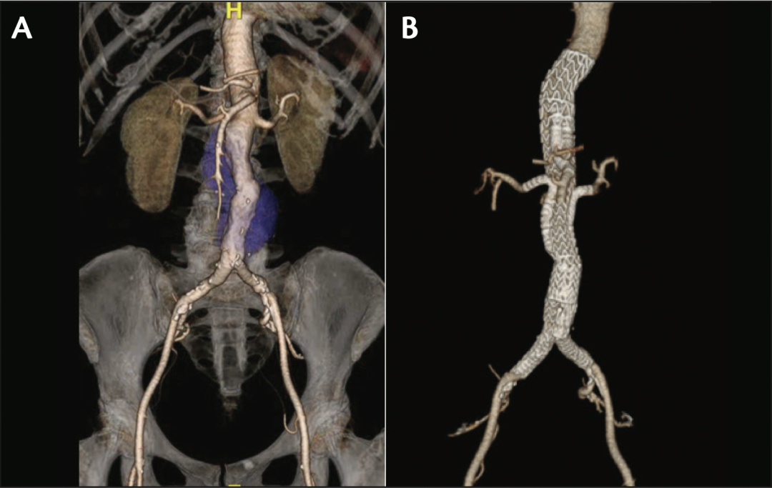 gore医疗怎么样TAMBE重塑复杂主动脉瘤治疗格局的技术解析_https://www.jmylbn.com_新闻资讯_第10张